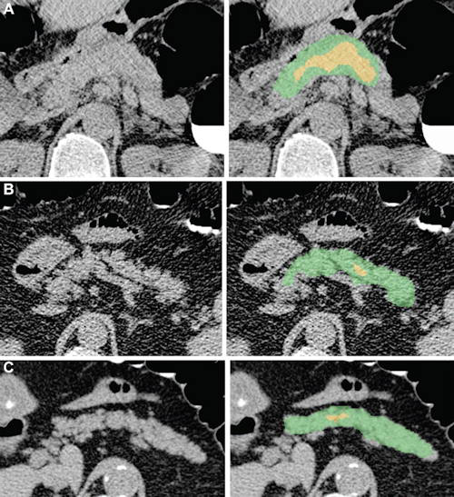 Examples of pancreas segmentations on unenhanced axial abdominal CT images in healthy participants and patients with type 2 diabetes mellitus
