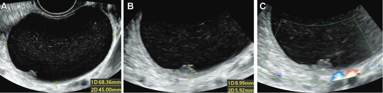 Ultrasound images in 36-year-old woman show a unilocular cyst with a solid component in the right ovary