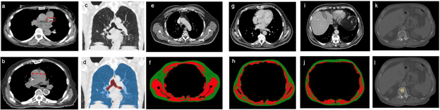 Axial CT image shows coronary artery calcium