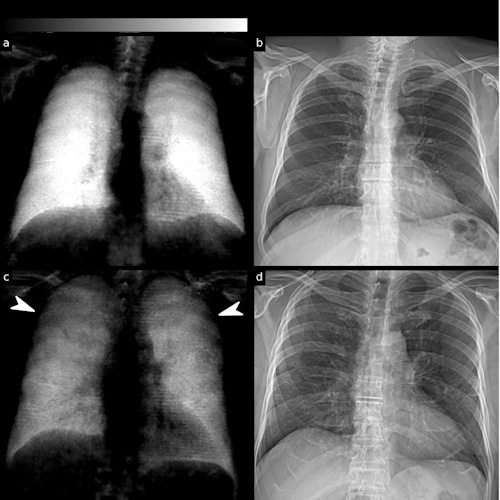 Dark-field and conventional chest radiographs of a healthy subject