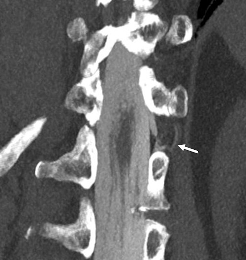 Coronal 3 mm maximum intensity projection image of a CSF venous fistula