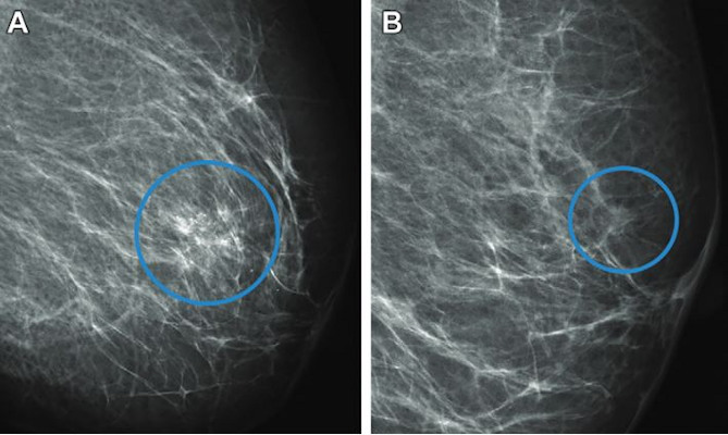 A full-field digital mammogram of a 61-year-old woman shows a diagnosed interval cancer that was automatically recalled by the AI system