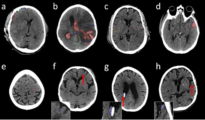 Illustrative head noncontrast CT axial images with predicted and reference segmentations