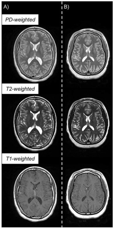 Example of triple turbo spin-echo brain MRI scans in neurotypically developing and atypically developing extremely preterm-born adolescents
