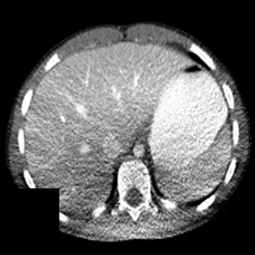 Shading artifacts as a result of beam hardening can be seen on the CT scan in the posterior region of the patient