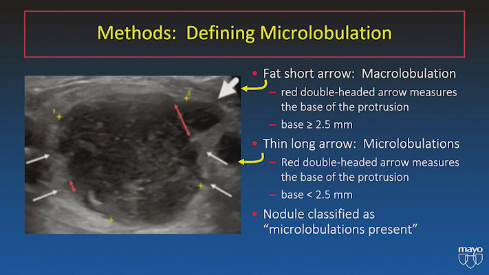 TI-RADS has been used as a standardized method for classifying thyroid nodules