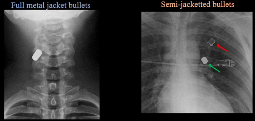AP radiograph of cervical spine demonstrates single-density well-defined bullet within right posterolateral soft tissues of neck at C4 level