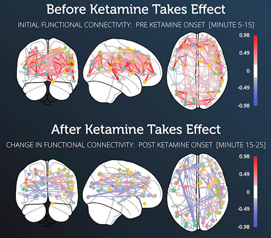 Absolute functional connectivity in a research subject for minutes five to 15 after he received the intramuscular injection of ketamine