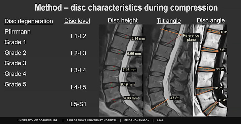 Research presented at the annual ISMRM says that a novel MRI registration method can track changes in intervertebral discs noninvasively while characterizing disc structures