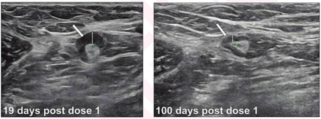An increased cortical thickness of 4 mm is seen in a transverse image of left axilla on initial breast ultrasound in a 33 year old woman