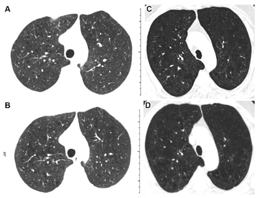 Inspiratory axial noncontrast CT scans obtained at baseline and five-year follow-up in two participants demonstrate emphysema progression