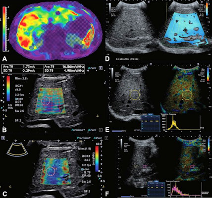 Images show MR elastography and quantitative ultrasound images in 16 year old boy with Fontan-associated liver disease and elevated liver shear stiffness