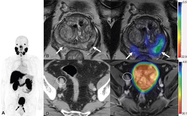 Images show F-18 DCFPyL PET/MRI and contrast-enhanced CT in a 65-year-old man with clinical T3 stage prostate cancer who underwent bone scintigraphy with negative findings