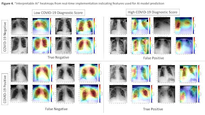 Interpretable AI heatmaps from real-time implementation indicating features used for AI model prediction