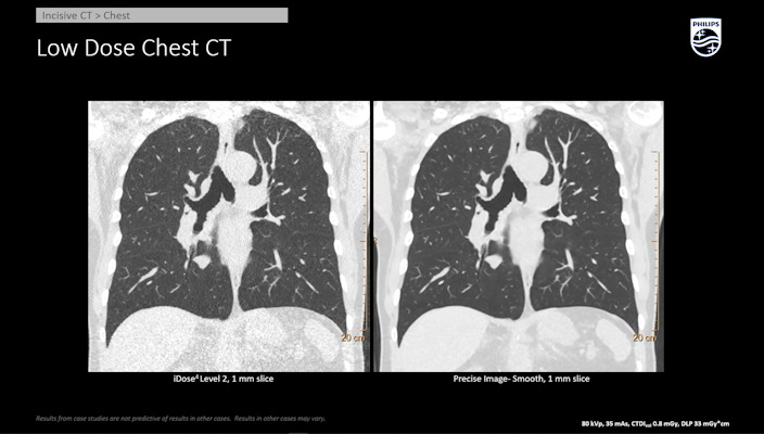 Chest scanned on incisive CT and reconstructed with Precise Image