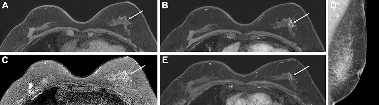 Images show a 57-year-old woman who had contralateral breast tumor recurrence detected at abbreviated MRI 30 months after breast-conserving surgery