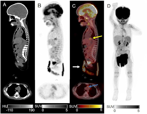 CT PET and fused PET/CT in sagittal axial and maximum intensity projection reconstructions