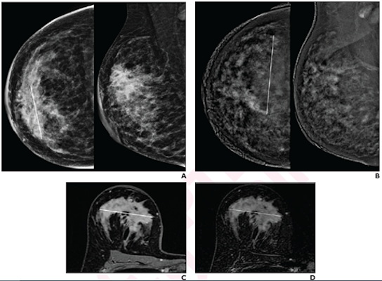 Low-energy images from contrast-enhanced mammography