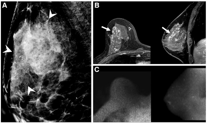 Images of a 46-year-old asymptomatic woman diagnosed with intermediate-grade ductal carcinoma in situ by 14-guage needle biopsy