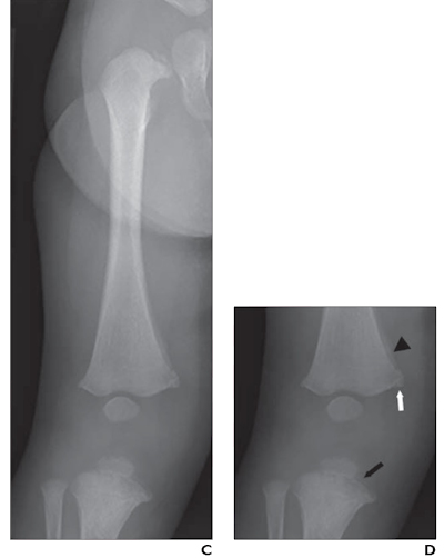 a 4 month old boy with knee classic metaphyseal lesions diagnosed with child abuse and with vitamin D deficiency