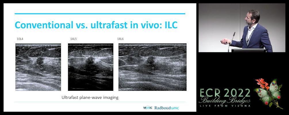 Ultrafast ultrasound imaging will play a more prominent role in supplemental breast cancer screening in 2025