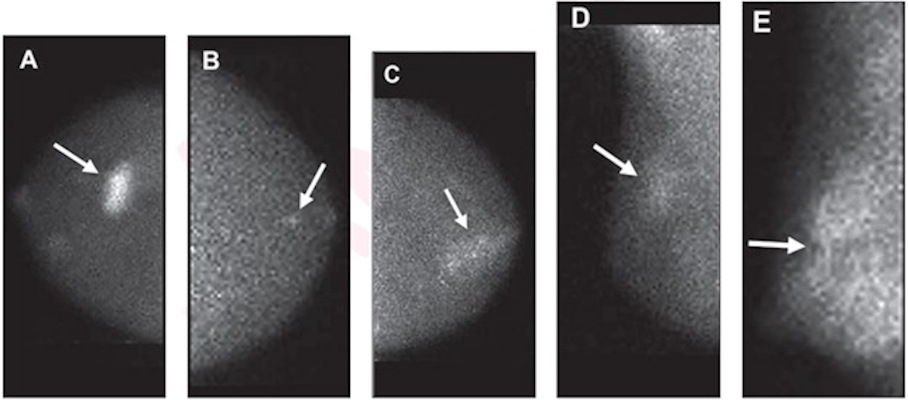 Molecular breast images show mass with marked intensity of uptake