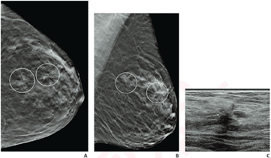 Craniocaudal and mediolateral oblique DBT images show two areas of architectural distortion in upper outer left breast that persisted on additional diagnostic tomosynthesis images 