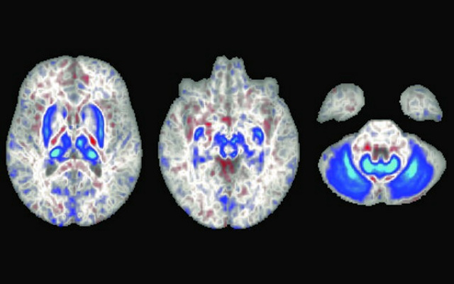 In these brain scans blue areas indicate regions with iron accumulation in individuals with two copies of the hemochromatosis risk gene