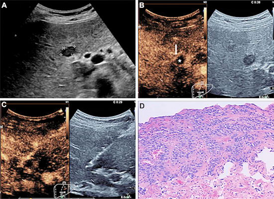 CEUS images show a change of the biopsy target area in a 54-year-old woman who presented with a two-week history of epigastric discomfort