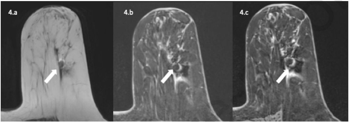 A 63 year old patient with invasive ductal carcinoma marked by an Ultraclip metallic marker and treated with neoadjuvant chemotherapy underwent a preoperative 1.5T MRI exam with T2-weighted, 3D T1-weighted VIBE before and after contrast media injection