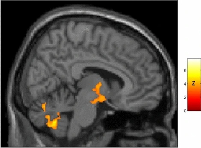 A sagittal view (right of midline; X = 8) of whole-brain statistical z-map showing regions where brain age-correlated TSPO expression was greater in women than men, with prominent results in a region spanning both the hypothalamus and thalamus (hypothalamus peak: X = 11, Y = -7, Z = - 13 [Z = 4.2]; thalamus peak: X = 4, Y = -6, Z = 0 [Z =5.1]; center of gravity in the hypothalamus: X = 10, Y = -5, Z = -9