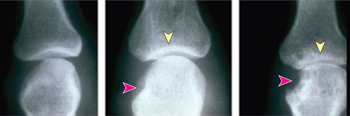 Representative radiographs showing joints without disease and joints with mild and severe damage due to rheumatoid arthritis
