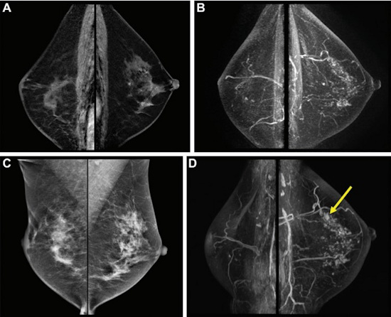 Postoperative surveillance images in a 54 year old woman who had undergone right breast conserving surgery and postoperative radiation therapy two years prior for stage III hormone receptor-positive invasive ductal carcinoma