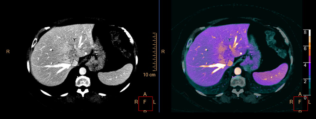Bariatric patient scanned on Spectral CT 7500 demonstrating excellent image quality and better visualization of this inoperable cholangiocarcinoma with fused iodine result review