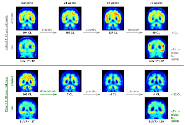 Representative amyloid and tau PET scans showing changes after placebo and donanemab treatment over the course of 76 weeks