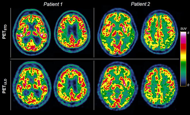 Transverse slices of two patients suspected of Alzheimer disease with mild hypometabolism and severe hypometabolism with standard dose and ultralow dose protocol