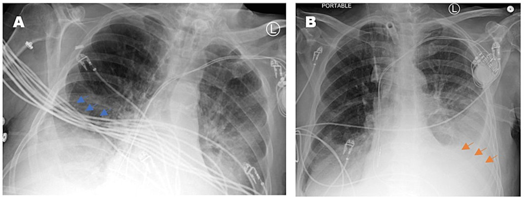 Two portable chest x-rays from a patient acquired at different times of the same day