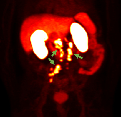 F18 rhPSMA PET image showing prostate cancer spread beyond the prostate region