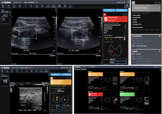 Koios DS is an ultrasound AI platform for assessing breast and thyroid lesions