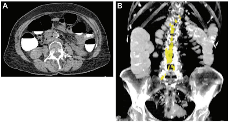 Abdominal aortic calcium in a 74 year old woman who underwent CT colonography for colon cancer screening in 2008 and suffered a subsequent acute myocardial infarction one year later