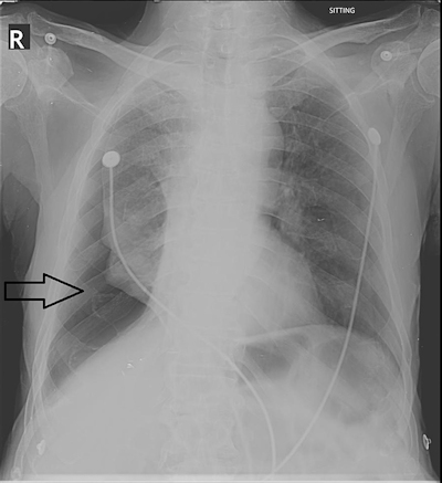Right-sided pneumothorax