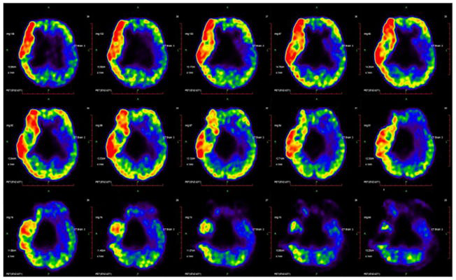Pattern related to cerebral palsy is identified by analysis of F 18 FDG PET scans from 31 patients
