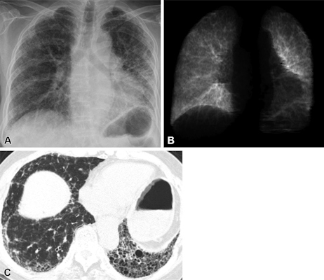 mages of a 72 year old woman with idiopathic pulmonary fibrosis