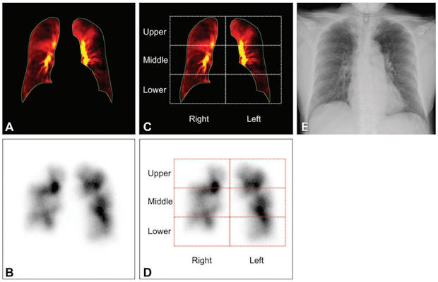Images in a 61 year old woman with chronic thromboembolic pulmonary hypertension