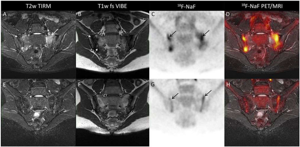 Atherosclerotic inflammation captured by F-18 FDG-PET/MRI. Image courtesy of Seminars in Nuclear Medicine