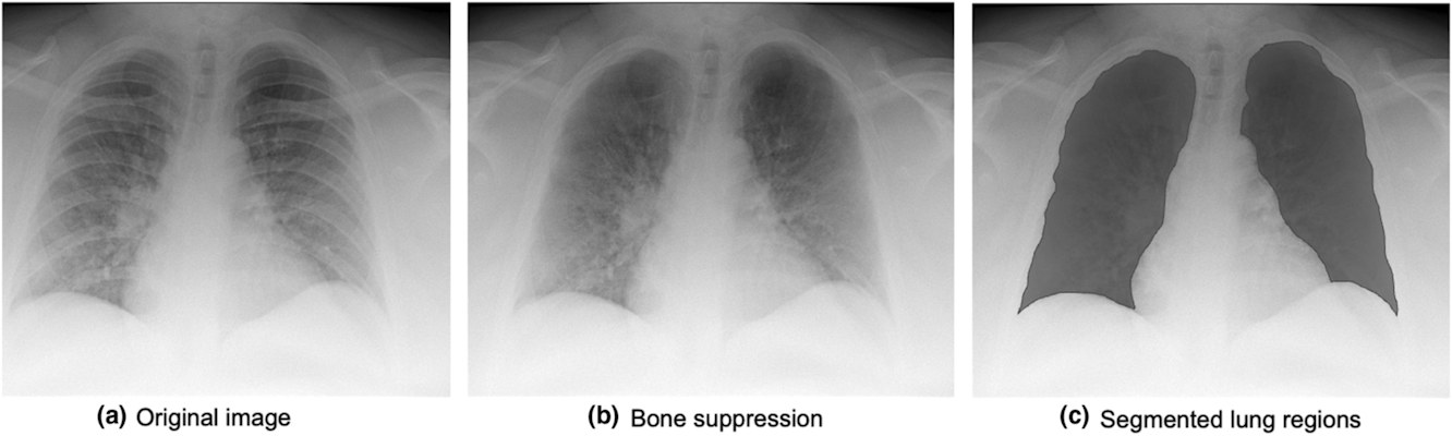 Examples of images with bone suppression and manually segmented lung regions