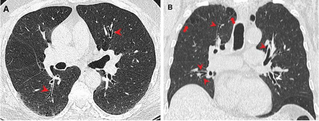 CT images show airway changes in a 66 year old male marijuana and tobacco smoker