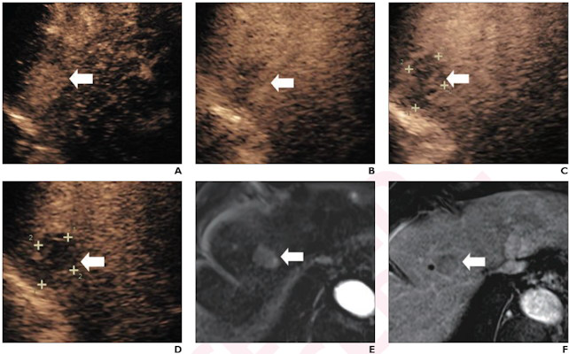 Arterial-phase CEUS image shows a 25-mm segment-8 lesion with non-rim hyperenhancement
