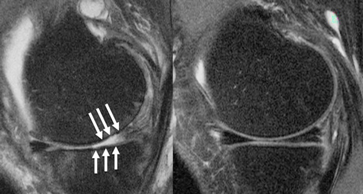 A knee joint of a patient on imaging shows severe cartilage defects and an intact knee joint