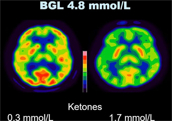Effect of serum ketone level on cerebral SUV